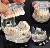 Arts et artisanat Modèle de dents de la maladie des implants dentaires avec dent de dentiste de la restauration pour l'étude de l'enseignement scientifique 18130777