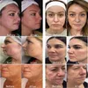 Máquina de beleza facial fracionário fracionário em microaneedling tratamento de acne remoção de rugas encolher poro de poros de pele de rejuvenescimento Equipamento de clareamento