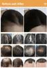 REGROTO DE CABELO TAIBO Alta frequência/650nm Rebropamento a laser/Máquina do couro cabeludo Equipamento de beleza de rebrota de cabelo