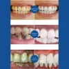 Crega dentária Reparo de cáries Remoção de cárie de manchas de placa decaimento de decaimento de clareamento de dentes de dentes de dentes de dentes 2023 nova pasta de dente