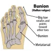 Leczenie separator stóp Hallux Valgus Corrector Orthotics Stopa Kość kciuka korekta korekta Pedicure Sock Sock