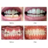 Accessori Dental Appliance Dente Ortodontici BREATURE ALLENSIONE DENTALE DENTALE ALLINEARE ALLINEA BUNCALLATTO DELL'ARTODONTICA ORTODONTICA