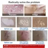 311NM NBAND ULTRAVIOLET UVB LAMP UV Potherapy Instrument Treatment Anti vitiligo Phiriasis White Spot Skin 240424
