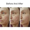Novo dispositivo de beleza facial para cuidados com os olhos facial use home wrinkle linha fina remoção de pele levantamento de rejuvenescimento