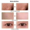Instrument Ultrassonic Skin Spurbroping Facial descascando o removedor de cravo de cravo profundo, limpeza de face poro de espátula ultrassônica de limpeza de face de pele lavadora de pele