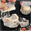 Konst och hantverk Dental Implant Disease Teeth Model With Restoration Bridge Tooth Dentist for Science Teaching Study13594528 Drop Del DH9NR