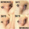 Tongringen Sile Piercing Healing Discs Flexibele Hyperplasie Schotel Oor Stud Lip Ring Neus Zachte Pakking Anti Invaginatie Dr Dhgarden Dhacm