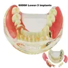 Outros dentes de implante dentário de higiene oral modelo M6006 Typodont Overdenture 3 implantes ponte inferior inferior tratamento de restauração estudo de demonstração ensinar 230915