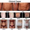 Emslim fettförlust Hiemt Slimming Body Cryolipolys Cellulite Reduction Machine Vikt Minska Byggmuskelanordningen med 5 handtag