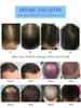 الأكثر فعالية ديود الجمال ليزر الجمال الآلي الأداة الجراثيم علاج تساقط الشعر 660NM المنزل التحليل الكهربائي نمو الشعر معدات إزالة الشعر المضاد للهر LED النمو