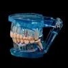 Andere orale hygiëne tandheelkundige implantaatziekten Tanden Model voor medische onderwijs Orale gezondheidszorgwetenschap Tandheelkundige Disease Teaching Studie 230815