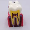 Other Oral Hygiene 1 pc Dental Materials Lab Teeth Model 6 Times Caries Comparation Study Models For Dentist Studying and Researching 230815