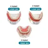 Andra orala hygieniska tandimplantatåterställning Tänder Modell Överdrivning Superior Demo Model Demonstration Tänder Modell 230824