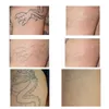 Andra hälsoskönhetsartiklar nd yag picosecond lasermaskin tatuering avlägsnande ipl rf nd yag laser hårborttagning maskin