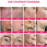 itens de beleza laser picossegundos 1064nm 532nm Remoção de tatuagem de marca de nascença nd yag espectros tonificando tonificação de melasma de melanas de carbono facial de carbono