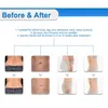 2022 Diseño único Cryolipolysis Congelación de grasa Adelgazante Tecnología fresca 3 manijas criogénicas Máquina de eliminación de celulitis por congelación de grasa