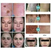 Nd yag laser détatouage portable q switch rajeunissement de la peau lazer pigmentation traitement équipement de beauté multifonctionnel