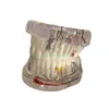 Sinir İmplante ile Diğer Ağız Hijyeni Diş Eğitim Diş Modeli Şeffaf Patolojik Onarım Öğretim Gösteri Modeli 230506