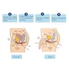 البيع الساخن كرسي مقعد العضلات في الحوض للعلاج emslim ed عضلة السعادة من أجل تعزيز علاج تسرب البول الحساسية الجنسية