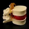 その他 オフィス学用品 小道具モデル 送料無料 解剖学的脊椎腰椎椎間板ヘルニア解剖学教材 230703