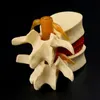 その他 オフィス学用品 小道具モデル 送料無料 解剖学的脊椎腰椎椎間板ヘルニア解剖学教材 230703