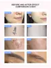 OPT Laser RF 3 in 1 E-light Macchina per la depilazione Laser Nd Yag Macchina per la rimozione del tatuaggio Face Lifting Picosecond Q-Switch