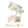 Inne higiena jamy ustnej model dentystyczny Implant Most Restoration Bridge Badanie Nauka choroby dentysta stomatologia Produkty dentysty