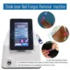 980 nm diode laser Onychomycosis behandelingsmachine nagelschimmelbehandeling Behandeling ontdoen van teennagelschimmel