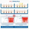 Máquina de depilación DPL IPL para eliminación de vasos sanguíneos rojos, rejuvenecimiento de la piel, blanqueamiento de pecas y acné