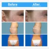 7 in 1 80k Ultrasuoni Lipolisi Cavitazione RF Macchina Dimagrante Sottovuoto Pressoterapia Liposuzione Body Sculpting Per La Riduzione Della Cellulite Apparecchiatura Di Bellezza