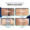 2023 Newest Safety Needling Fractional RF Device Needle Acne Treatment Radio Frequency Skin Rejuvenation RF Microneedling Face Lifting Needle Beauty Device
