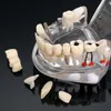 Andra munhygienimplantat Dental Disease Teeth Model With Restoration Bridge Tooth Dentist for Science Teaching Study Tool 230228