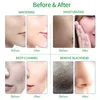 4 في 1 Hydra Mermabrasion Machine Facial Deep Cleansing Skin Lifting Remoft