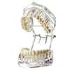 Outros Higiene Oral Modelo Dentário Dentes Implante Restauração Ponte Ensino Estudo Ciência Doenças Dentista Produtos Odontológicos Presente Odontológico 230609