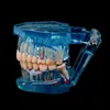 Other Oral Hygiene Dental Implant Disease Teeth Model With Restoration Bridge Tooth Dentist For Medical Science Dental Disease Teaching Study 230617