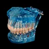 Outro modelo de dentes de doença de implante dentário de higiene oral com ponte de restauração dentista para estudo de ensino de doenças odontológicas de ciência médica 230617
