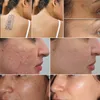 2023 Picoseconde Laser Carbone Peeling Rajeunissement De La Peau Pigment Détatouage q switch ND YAG lasers détatouage Machine