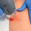 RF Needle يمكن التخلص من الخرطوشة الدقيقة الوخزّة الكسرية 25/49/81 لآلة RF MicroNeedling