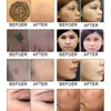 Multifuncional Picolaser Beauty Equipment Máquina de remoção de cicatrizes de tatuagem Pico Second Nd Yag Laser Q Switched Facial Skin Care Rejuvenescimento Vertical Salon Use