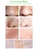 Lanbena Blackhead Remover Maskesi Koyu 3 İçinde 1 Yeşil Çay Yağı Siyah Kırıntı Kiti Gözenekler İçin Burun Çençeleri Yüz Güzellik Seti