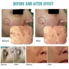 IPL Machine Skin Bruckening Rejuvenation Glowskin o Care Gel Bubber for Deep Cleaning التجاعيد