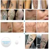 Láser profesional picosegundo luz azul roja eliminación de tatuajes pluma pecas acné lunares y manchas oscuras máquina de eliminación de pigmentos