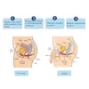 Sedia dimagrante per la riparazione dei muscoli del pavimento pelvico/Macchina per sedia per la riparazione dei muscoli del pavimento pelvico/Dispositivo per sedia per la riparazione dei muscoli del pavimento pelvico