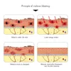 Profesjonalny pieg piegowy trądzik Mole Dark Spot Pigment Maszyna Portable picosekundowe laserowe urządzenie laserowe