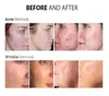 Skin Rejuvenation Laser Tube - Safe Wrinkle Removal & Vaginal Tightening for Beauty Salons - Affordable Price