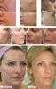 ثلاث نصائح محترفة الكسور RF Microneedle Radio Freuqency Face Lift Skin Canning Wrinkle Dots Matrix Machine