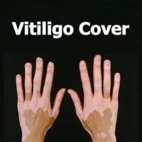Vitiligo Corrector líquido Pen a prueba de agua Vitiligo Patches Hidera natural Leucodermia Solución de cobertura de maquillaje instantáneo para enfermedades de la piel272g