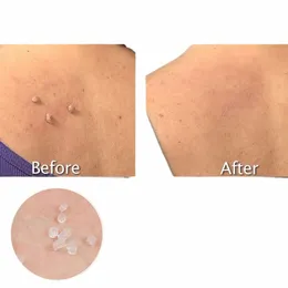 Nevus Ctracti Circles Skin Tag Remoção Ring Face Body Care Mole Wart Treat 66qW #