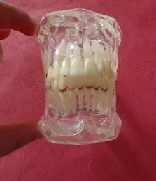 Zahnpathologiemodell mit Halbimplantat zeigt deutlich die ursprüngliche Form und die gesamte Struktur9198089