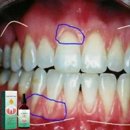 30 ml di riparazione rapida delle cavità carie gocce denti sier